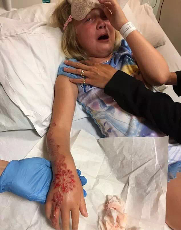 英国两娃玩黑色海娜纹身酿大祸，医生提醒：警惕染膏成分过敏