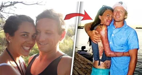 全身65%被烧伤，200多次手术，跑步让她浴火重生