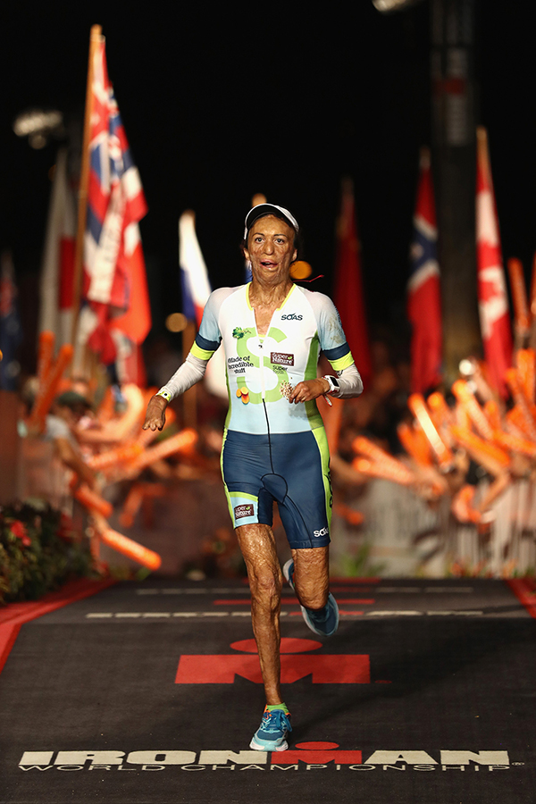 全身65%被烧伤，200多次手术，跑步让她浴火重生