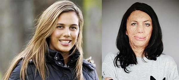 全身65%被烧伤，200多次手术，跑步让她浴火重生