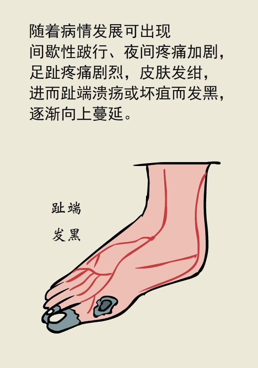 漫画｜太可怕了！抽烟居然会让手指脚趾烂掉......