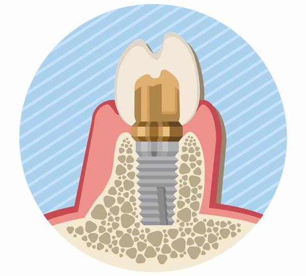 爱牙日｜牙齿也能“种”出来，这里有份种植牙攻略