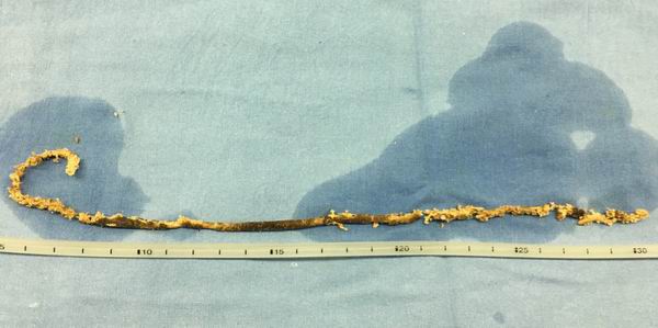 30厘米“石化”导管遗留体内20年，上海专家成功取石保肾