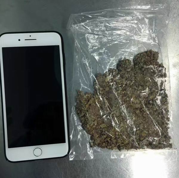 30厘米“石化”导管遗留体内20年，上海专家成功取石保肾