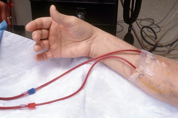 问答｜血液透析患者可用土豆保护动静脉内瘘？