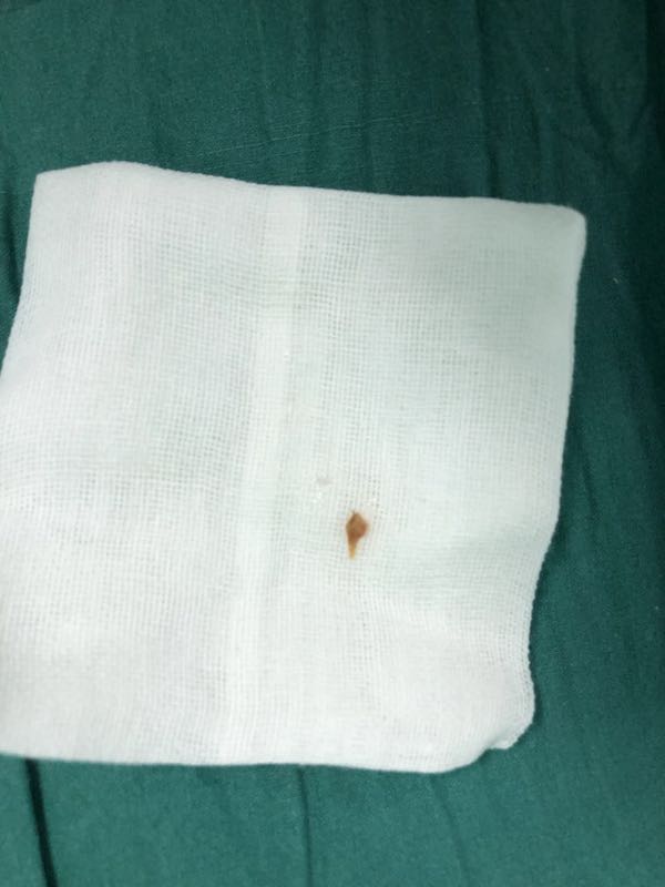 咳嗽不止，“元凶”竟是一年前卡住的鸡骨头