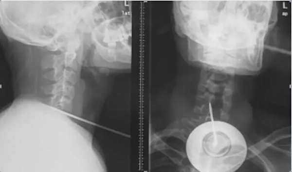 17厘米钢针剌入颈部，多学科联手成功抢救多器官破裂患者