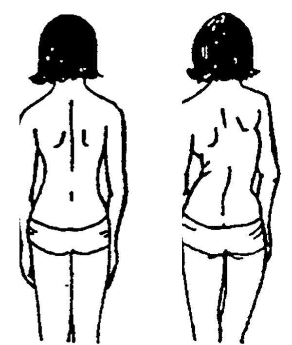 视频｜青少年脊柱侧弯如何自查？