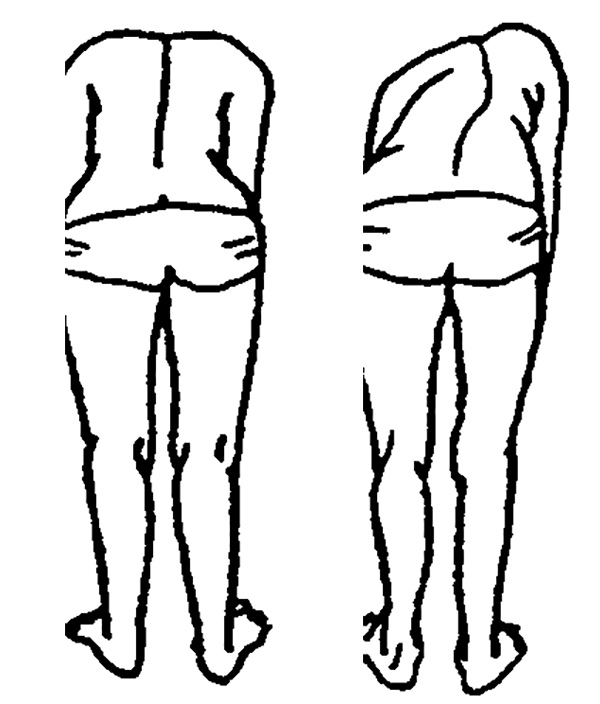 视频｜青少年脊柱侧弯如何自查？