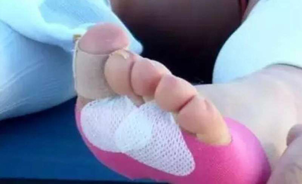 看过的跑友都说疼！这些容易磨破的部位，我们该如何保护