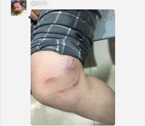 上海浦东数人被流浪犬咬伤，专家：气温上升犬伤就诊人数增加