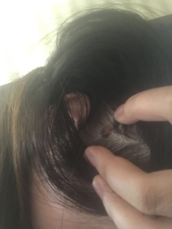 问答｜哪些痣必须切干净，娘胎带的痣就没危险吗？