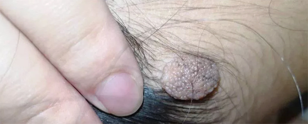 问答｜哪些痣必须切干净，娘胎带的痣就没危险吗？