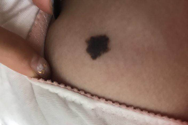 问答｜哪些痣必须切干净，娘胎带的痣就没危险吗？