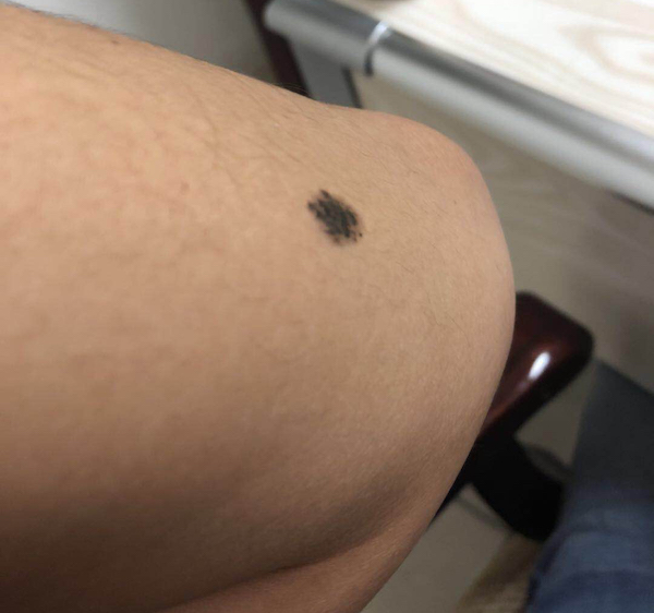 问答｜哪些痣必须切干净，娘胎带的痣就没危险吗？