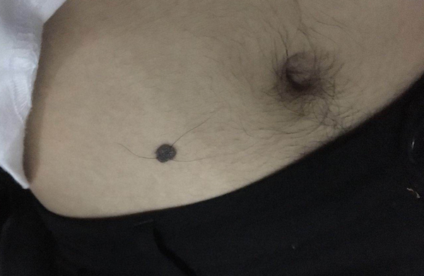 问答｜哪些痣必须切干净，娘胎带的痣就没危险吗？