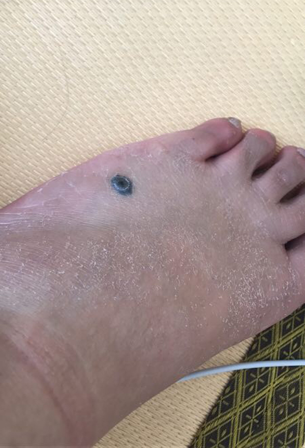 问答｜哪些痣必须切干净，娘胎带的痣就没危险吗？