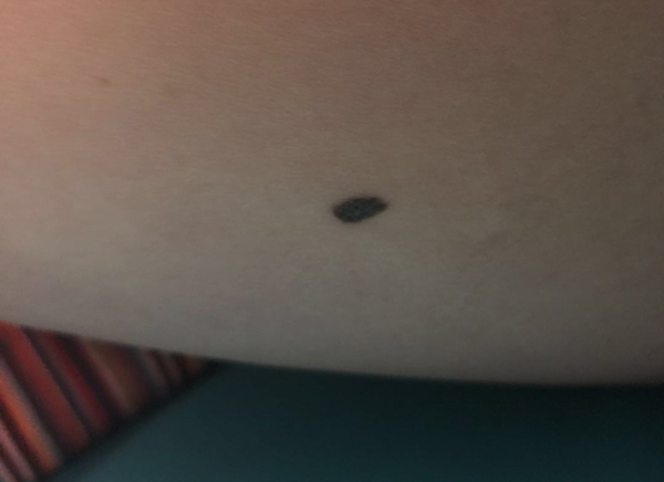 问答｜哪些痣必须切干净，娘胎带的痣就没危险吗？