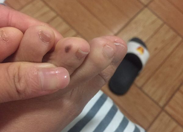 问答｜哪些痣必须切干净，娘胎带的痣就没危险吗？