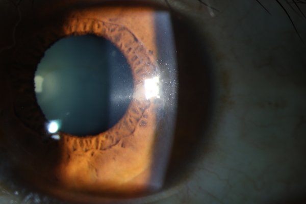 近视远视手术废弃透镜再利用，可望治疗角膜疾病