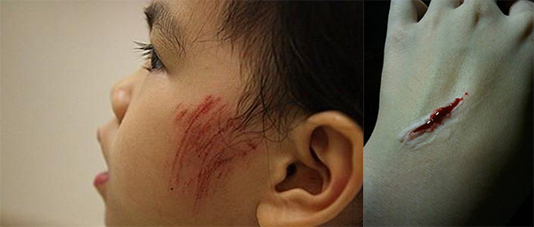 儿童烫伤、划伤、扭伤、流鼻血的急救处理误区