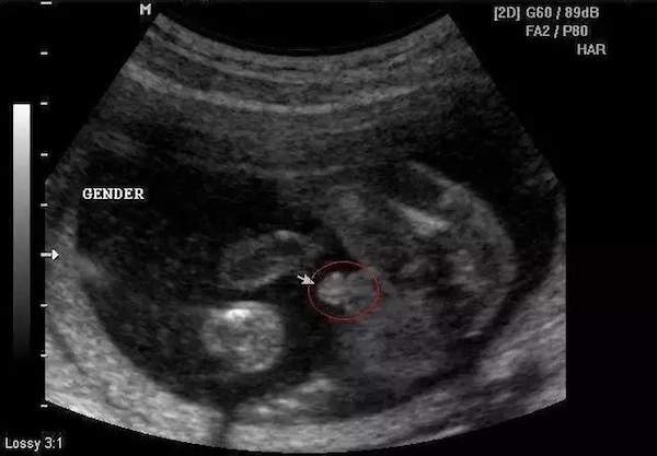 辟谣｜怀孕50天，超声看孕囊能看出男女？