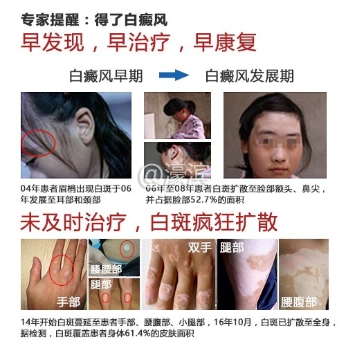 南通白癜风治疗怎么样?强化质量意识,确保医疗安全.