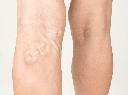 静脉曲张好多年了怎么治?左腿青筋明显能治好吗