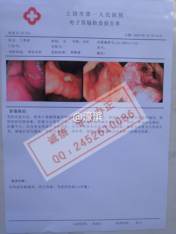 意外怀孕B超单，胃镜检查报告单，人流证明单