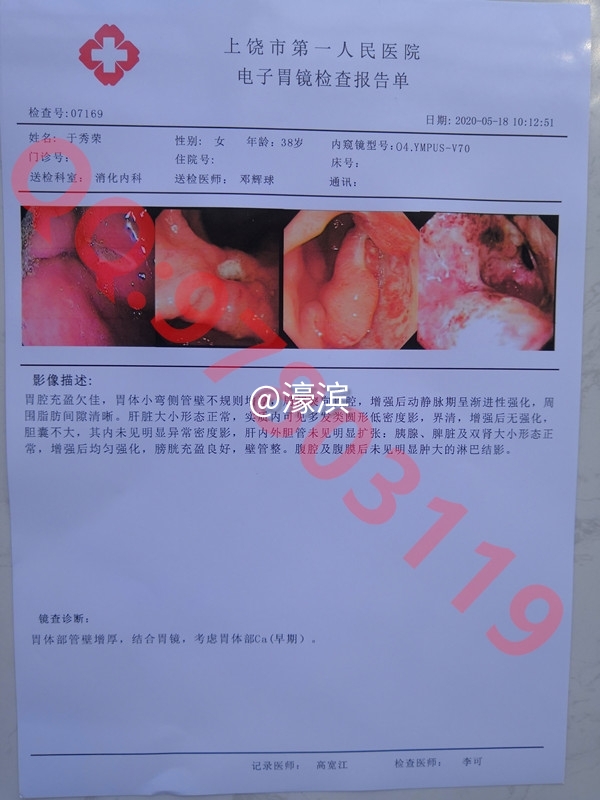 意外怀孕B超单，胃镜检查报告单，人流证明单