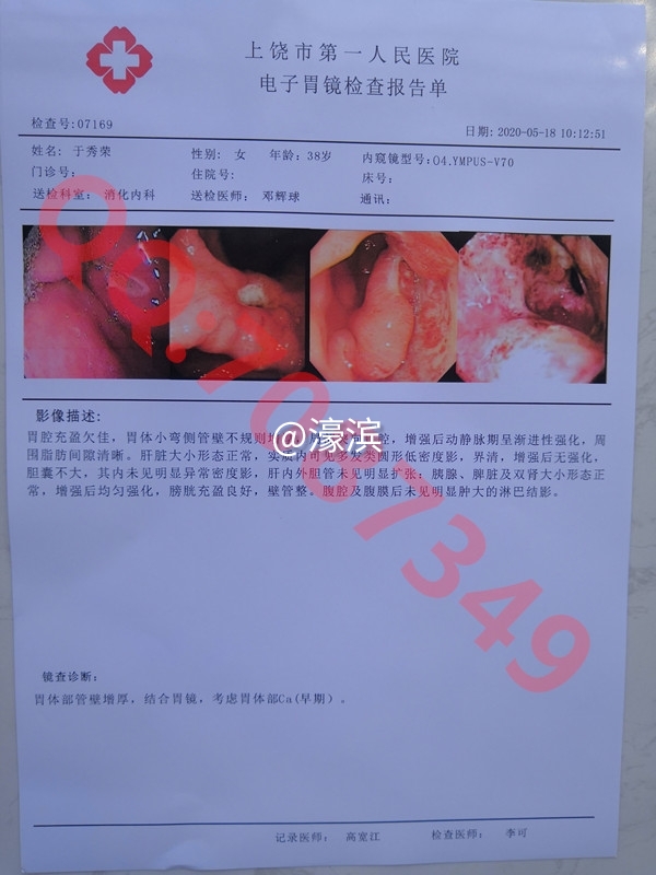 意外怀孕B超单，胃镜检查报告单，人流证明单