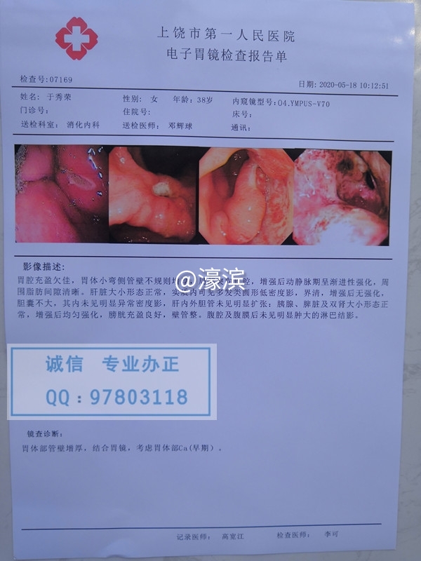 意外怀孕B超单，胃镜检查报告单，人流证明单