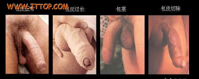 为提升人气,特开办讲座!第一课:什么叫包皮过长.图片由51MM倾情献身!